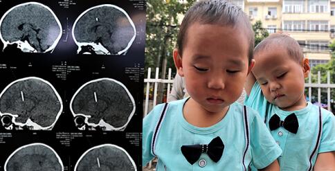 [视频]双胞胎兄弟出生后失明 脑内各发现1枚钢针