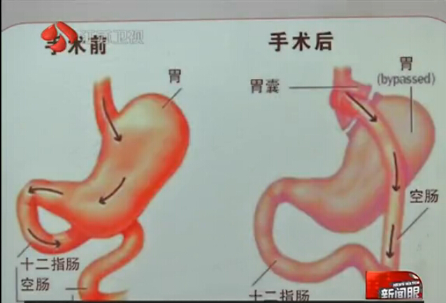 [视频]4岁男童重百斤 为减肥或将切除大部分胃