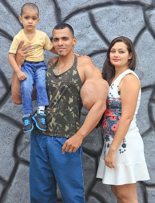 [视频]巴西男子手臂注射燃油变身绿巨人 差点被截肢