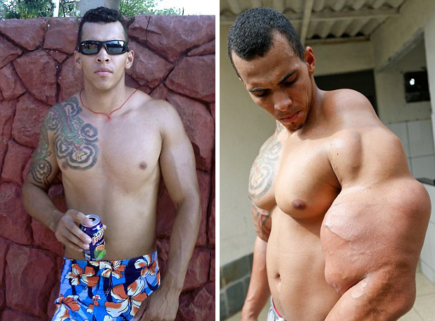 [视频]巴西男子手臂注射燃油变身绿巨人 差点被截肢