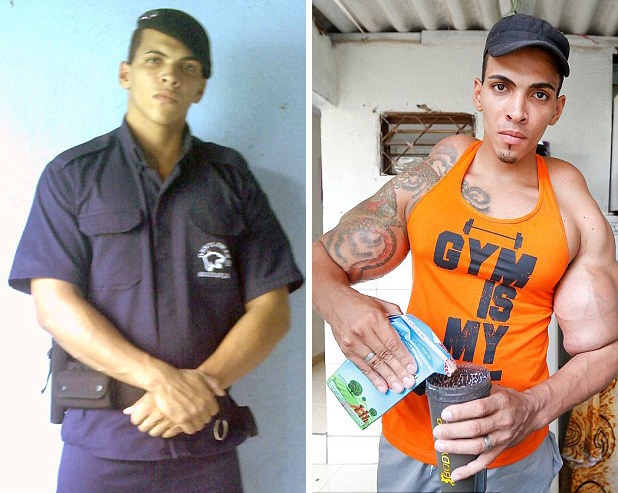 [视频]巴西男子手臂注射燃油变身绿巨人 差点被截肢