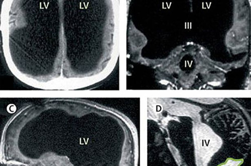 [视频]法国男子腿疼就医 却被查出大脑已消失过半体积