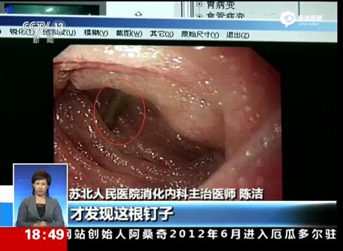 [视频]顽童意外吞钉致刺入肠壁 医生巧妙取出