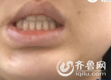 [视频]德州女子万元整容下巴被整歪 院方称“我笑我也歪”