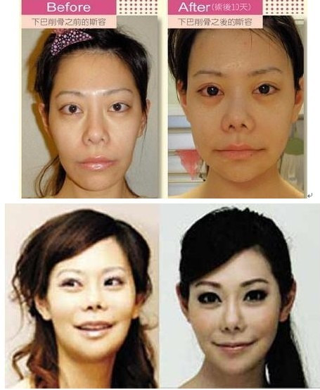 [视频]台主持斯容砸37万整形60次 抽脂丰额仿照金泰希 