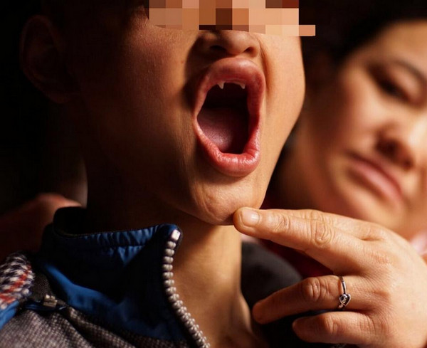 [视频]重庆15岁少年得怪病 长“獠牙”怕见光