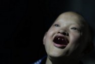 [视频]重庆15岁少年得怪病 长“獠牙”怕见光