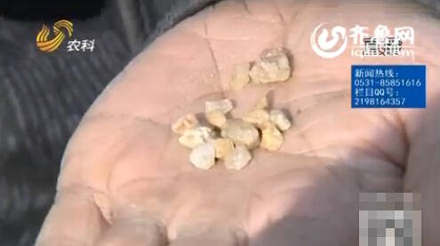 [视频]实拍女子眼睛里出石头 玉米粒大能挖出来