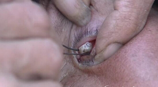 [视频]实拍女子眼睛里出石头 玉米粒大能挖出来