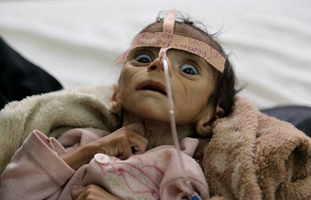 [视频]战殇 也门婴儿饥死
