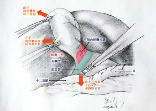 [视频]80后医生手绘手术解剖图 患者“秒懂”手术过程