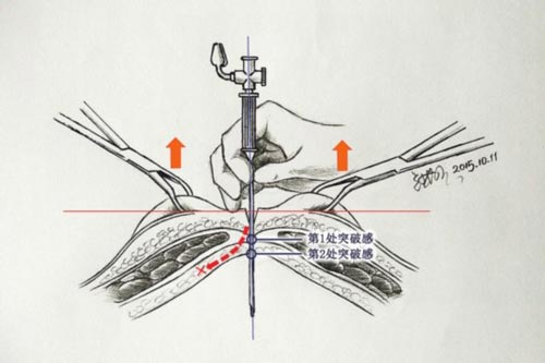 [视频]80后医生手绘手术解剖图 患者“秒懂”手术过程