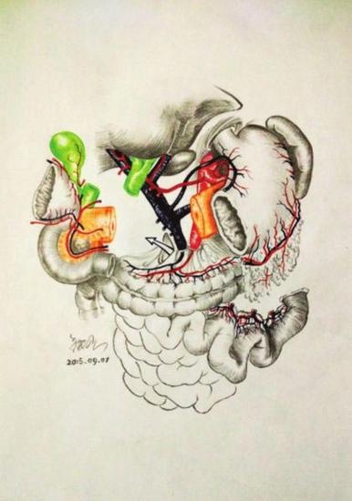 [视频]80后医生手绘手术解剖图 患者“秒懂”手术过程