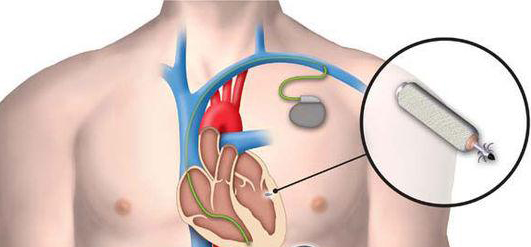 [视频]美国医生：装心脏起搏器更需提防防窃器